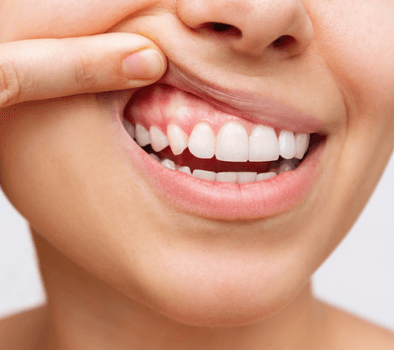 woman showing her top gums