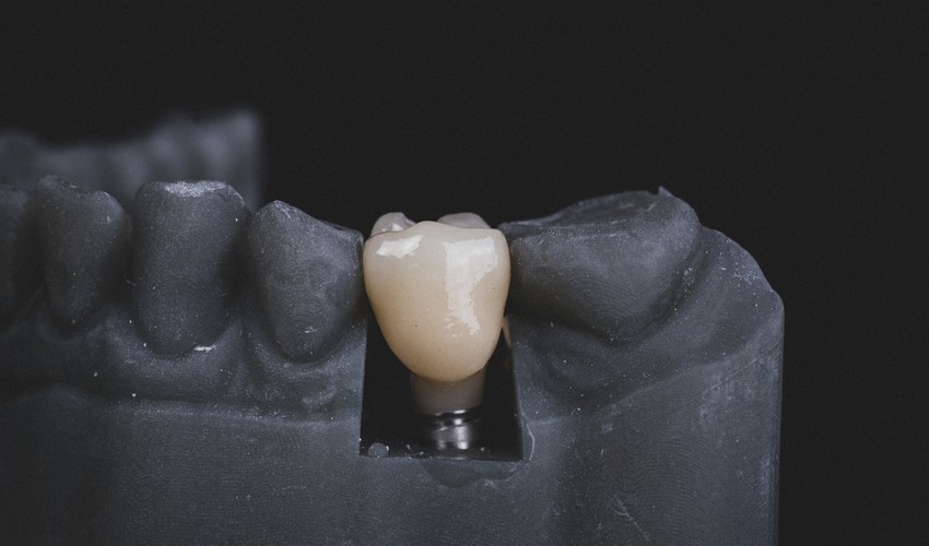 implant dentistry
