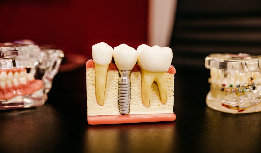 implant dentistry
